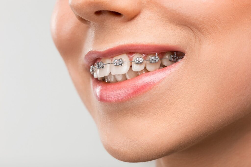 How Braces Influence Sleep Quality and Breathing Patterns